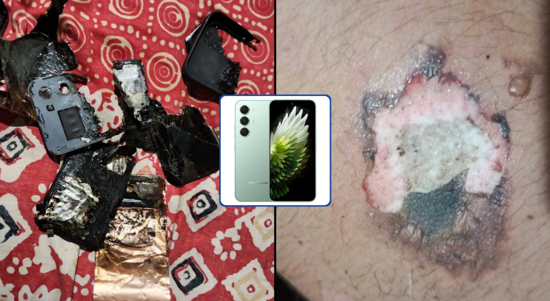 কুড়িগ্রামে পকেটে থাকা মোবাইল বিস্ফোরণ, যুবকের উরুতে দগ্ধ — অল্পের জন্য বড় দুর্ঘটনা এড়ালেন দুই ভাই