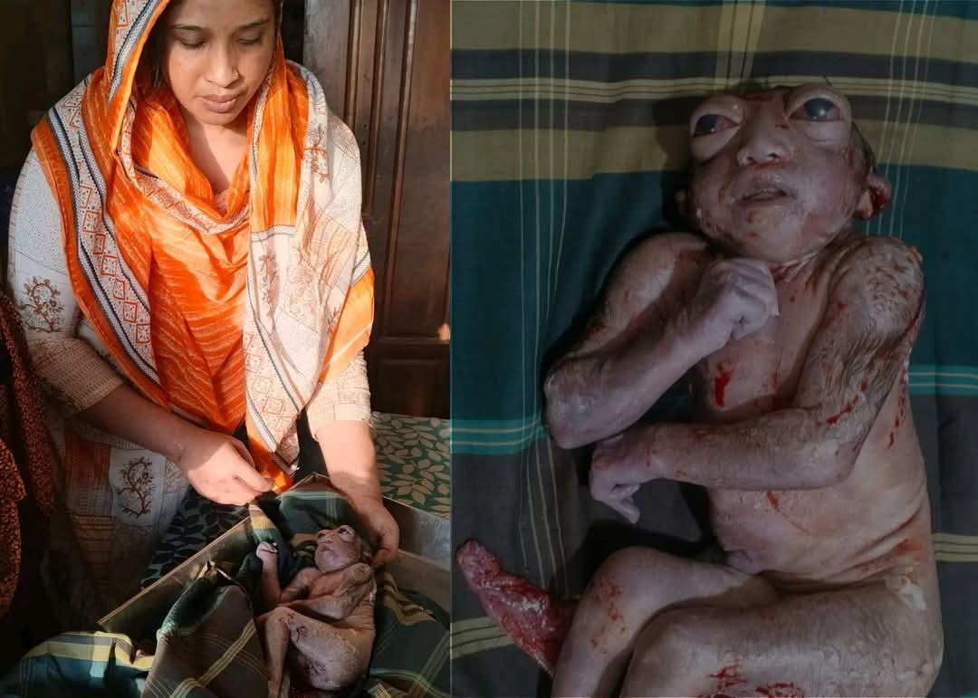 নাগেশ্বরীতে সিজারিয়ান অপারেশনে প্রতিবন্ধী শিশুর জন্ম